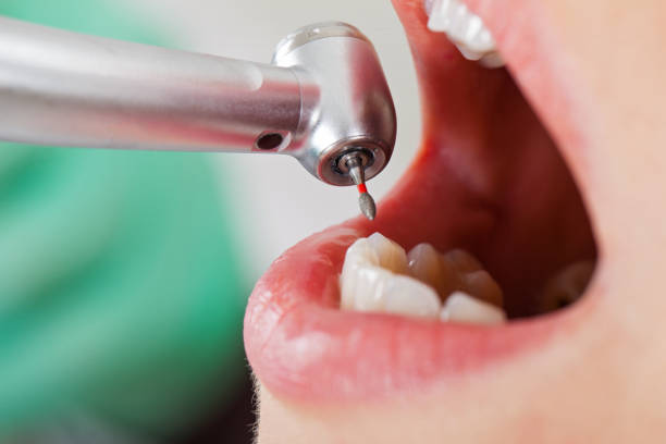 Best Dentist for Tooth Abscess  in West Monroe, LA